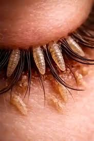 Are your eyes dry and itchy? It could be due to Demodex ...