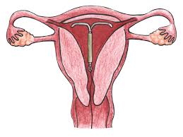 Image result for IUD image