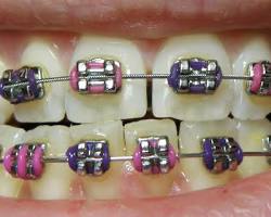 What are the types of Dental Treatment?