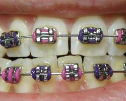 Dental braces