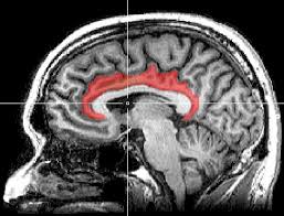 Tập tin:MRI cingulate cortex.png – Wikipedia tiếng Việt