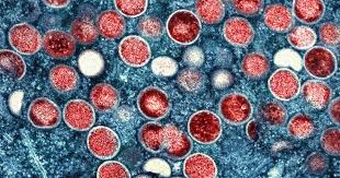 Mpox Strain Spreads Locally in U.S.: What You Need to Know