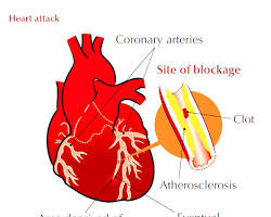 Image of Myocardial infarction diagram