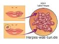 Gefährliche Viren: Herpes wandert womöglich durch die Nase ins