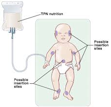 Image result for tpn