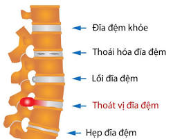 Image of Thoát vị đĩa đệm