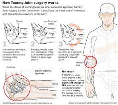 Image result for tommy john surgery