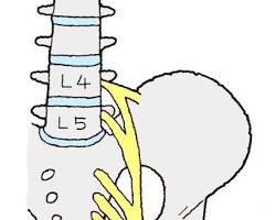 坐骨神経痛の感覚麻痺の画像