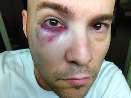 Luis Avilan, standing on the right, threw me a ball and then asked, “How&#39;s your eye?” (You may recall that I got a black eye on 7/31/13 at Turner Field and ... - zack_black_eye