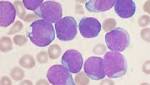  Study: CAR T-cell therapy safe and effective in youth with leukemia