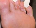 Champignons au pied - Mycose des pieds (pied d athlte) - Sant