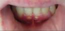 Comment identifier un abcs dentaire: tapes - How
