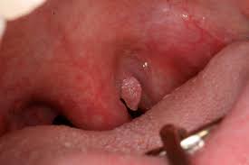 Image result for human papilloma virus