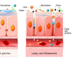 Gambar Leaky Gut vs Healthy Gut