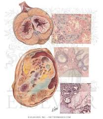 Image result for teratoma