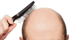 Image result for Hair Loss