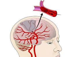 Image of Stroke diagram