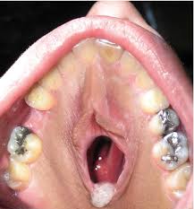 Image result for tonsilith