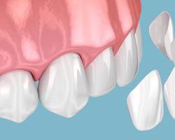 セラミックの歯の画像