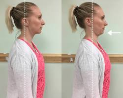 Hình ảnh về giải phẫu các nhóm cơ vùng cổ và bài tập chin tuck W stretch figure 4