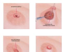 Image of Nipple correction surgery procedure