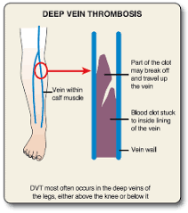 Image result for dvt