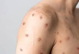 Mpox pode matar? Entenda riscos e letalidade da doença viral
