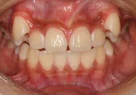 「八重歯」の画像検索結果