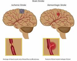 brain with a blocked blood vessel (ischemic stroke), a brain with a ruptured blood vessel (hemorrhagic stroke), and a brain with a subarachnoid hemorrhageの画像