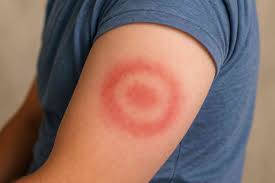 How Quickly Do Lyme Disease Symptoms Appear? - Chronic ...