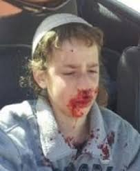 Noam Melamed, age 13, after Palestinian rock-throwers attacked the car in ... - noam-melamed-callout