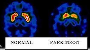 Resultado de imagen de párkinson