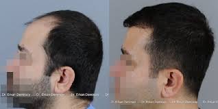 FUE Megasession - 4570 Grafts Dr. Erkan Demirsoy (Istanbul) (Hair Transplant) - 4681_image12