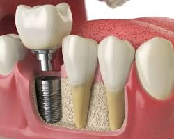 Dental implant placement surgery