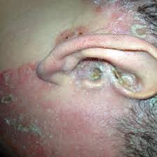 Image result for PSORIASIS