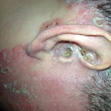 Image result for PSORIASIS