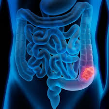 Cracking the code of early onset bowel cancer: the search ...