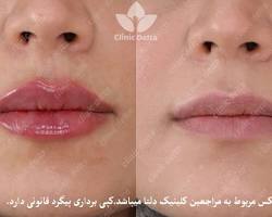 تصویر فیلر لب روسی قبل و بعد