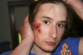 View full sizePhoto Courtesy of Samuel Snyder John Bayliss says this photo shows injuries state troopers inflicted on his son, James, on May 16, 2009. - bayliss-2jpg-886df36eaccd7c67