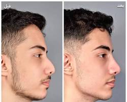 تصویر فیلر چانه