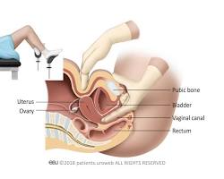 Image of Bimanual examination