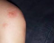 réaction allergique sévère punaise de lit bulles, généré par IA