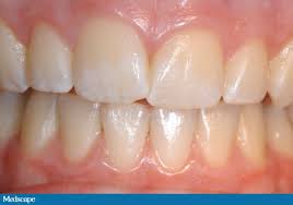 Image result for fluorosis