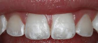 Image result for fluorosis