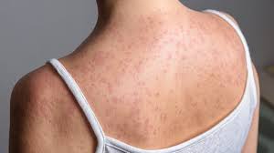 Drug-resistant strain of deadly 'ancient fever' that covers body in painful rash spreading to US