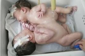 Image result for gambar KEMBAR SIAM