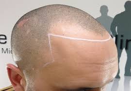 Image result for receding hairline stages