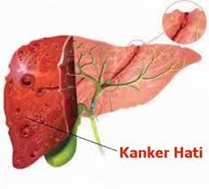 Image result for kanker