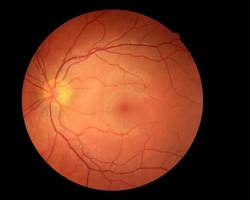 diabetic retinopathy retina scan nhs, AI generated