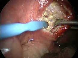 Image result for tonsil stones